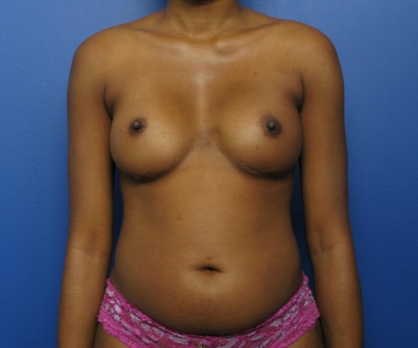 Breast Revisions After - Beverly Hills, CA
