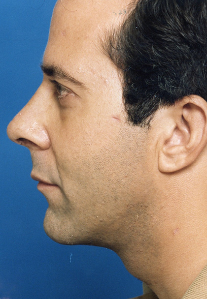 Chin Augmentation After - Beverly Hills, CA