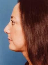 Chin Augmentation After - Beverly Hills, CA