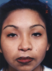 Cleft Lip & Nose Repair After - Beverly Hills, CA