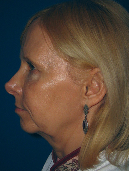 Facelift Before - Beverly Hills, CA