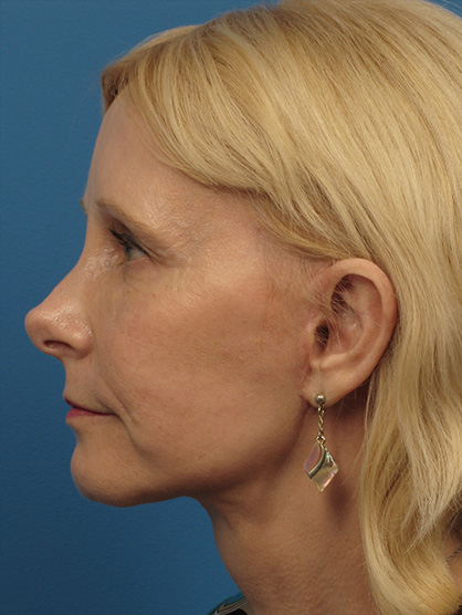 Facelift After - Beverly Hills, CA