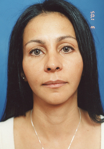 Facial Fat Grafting After - Beverly Hills, CA