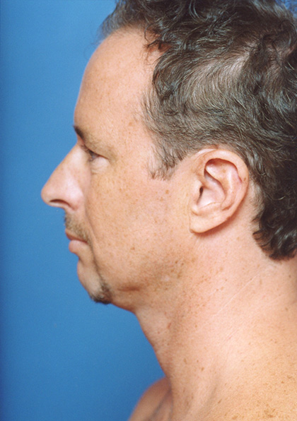 Facial Fat Grafting Before - Beverly Hills, CA