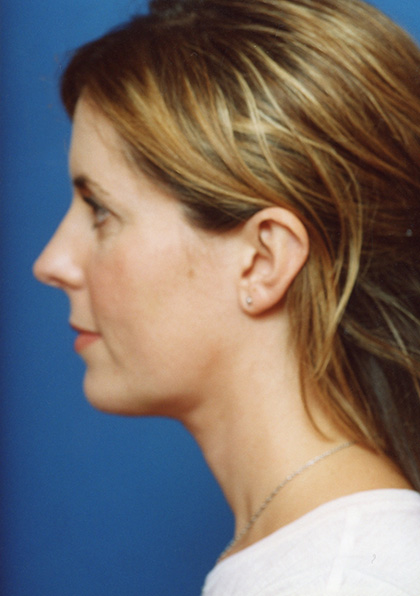 Facial Fat Grafting After - Beverly Hills, CA