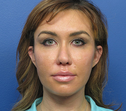 Facial Fat Grafting Before - Beverly Hills, CA