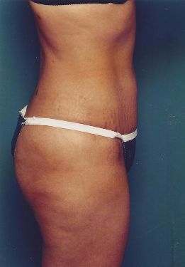 Liposuction After - Beverly Hills, CA