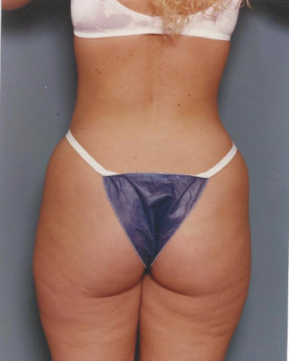 Liposuction Before - Beverly Hills, CA