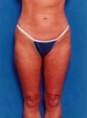 Liposuction After - Beverly Hills, CA