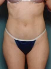 Liposuction Before - Beverly Hills, CA