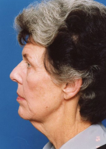 Neck Lift Before - Beverly Hills, CA