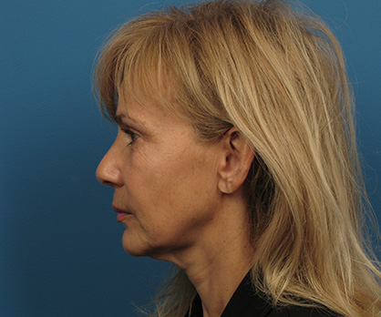 Neck Lift Before - Beverly Hills, CA