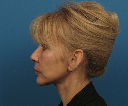 Neck Lift After - Beverly Hills, CA