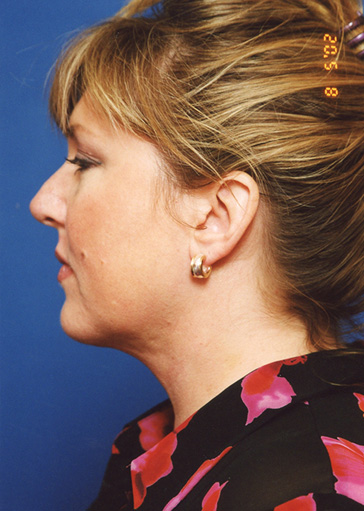 Neck Lift After - Beverly Hills, CA