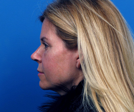 Revision Rhinoplasty After - Beverly Hills, CA