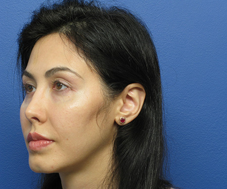 Revision Rhinoplasty After - Beverly Hills, CA