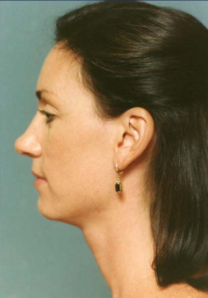 Revision Rhinoplasty Before - Beverly Hills, CA