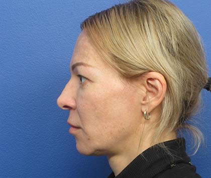 Revision Rhinoplasty Before - Beverly Hills, CA
