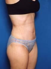 Tummy Tuck After - Beverly Hills, CA