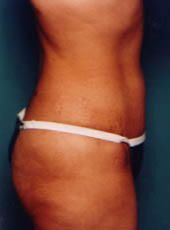 Tummy Tuck After - Beverly Hills, CA
