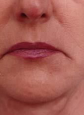 Wrinkle Reduction After - Beverly Hills, CA