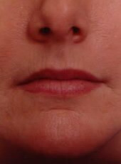 Wrinkle Reduction Before - Beverly Hills, CA