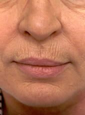 Wrinkle Reduction Before - Beverly Hills, CA
