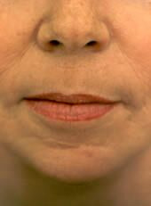 Wrinkle Reduction After - Beverly Hills, CA